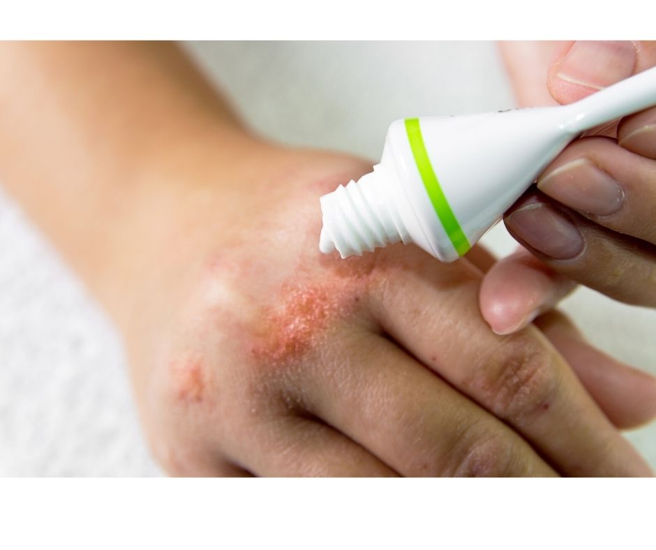 Eczema on skin, explaining the condition and the community around it