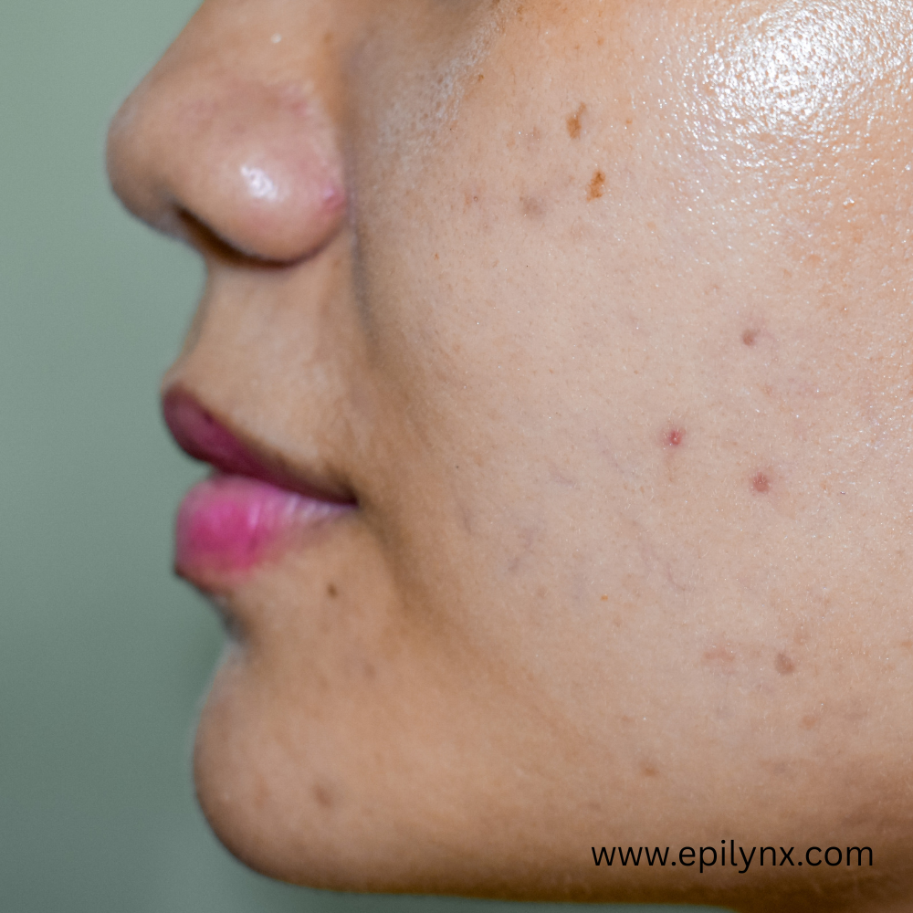 How to fade dark spots on sensitive and allergy-prone skin