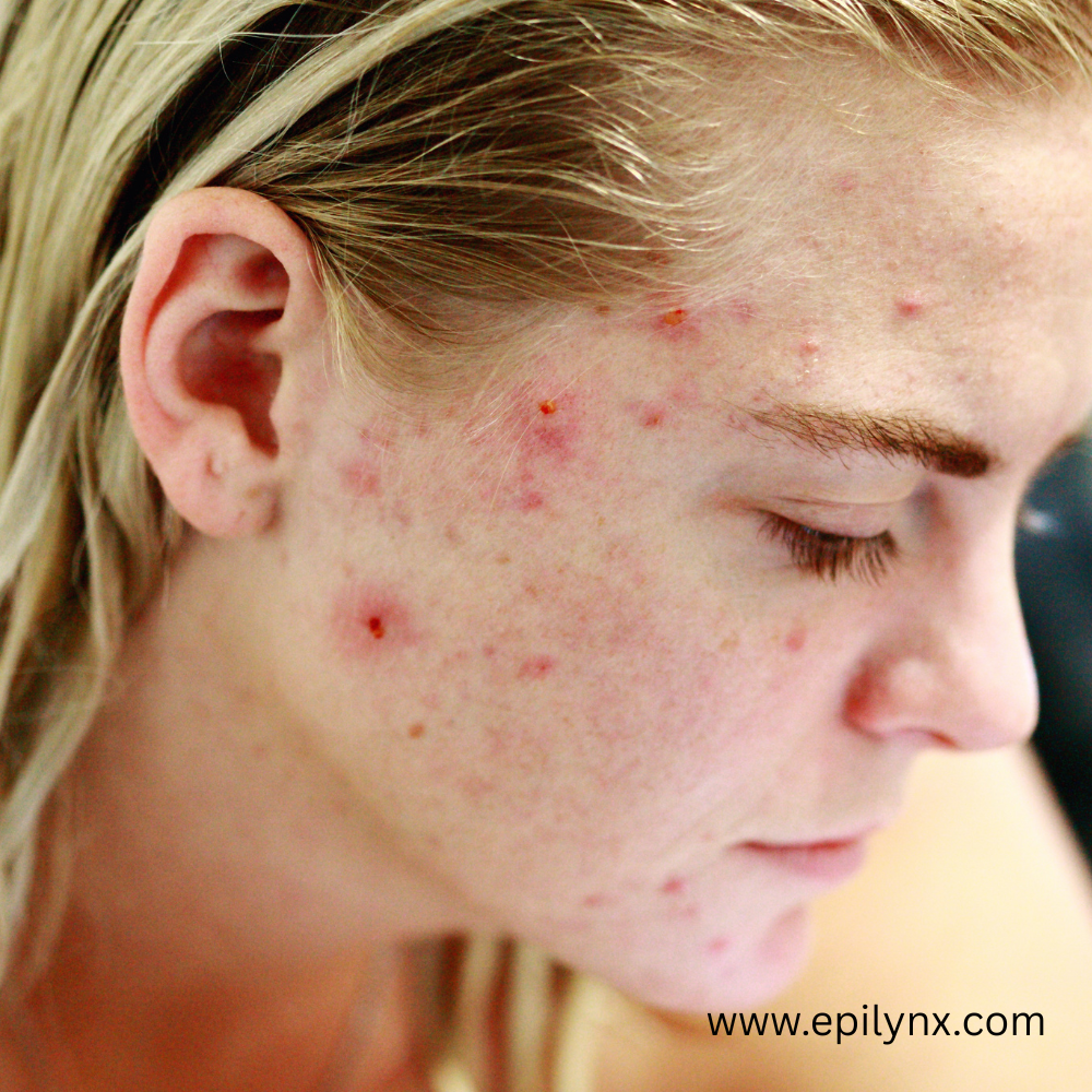 The hidden connection between adult acne and food allergies