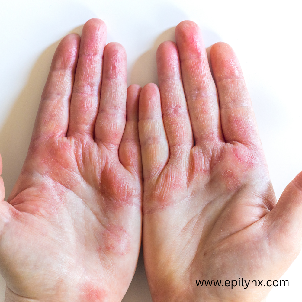 Contact dermatitis versus eczema and how to tell the difference