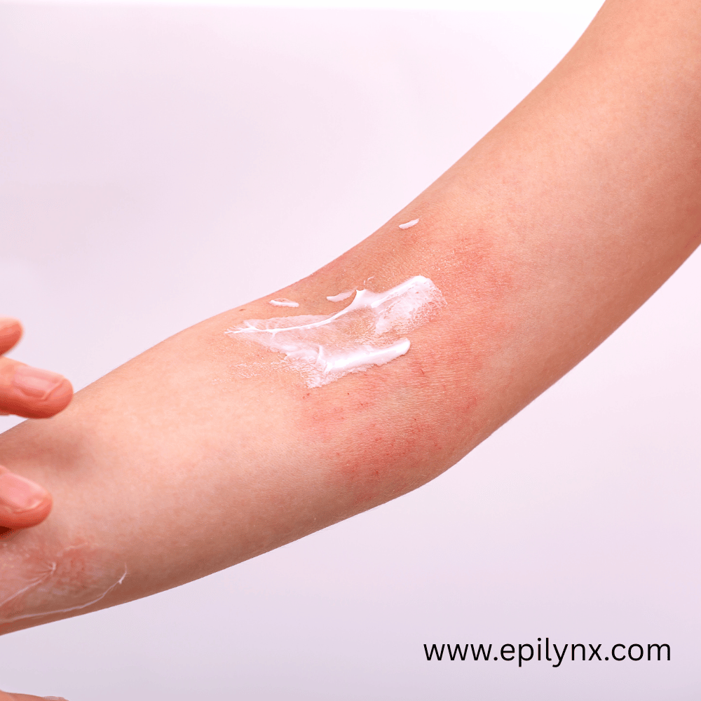 Dermatitis herpetiformis, the skin rash linked to celiac disease