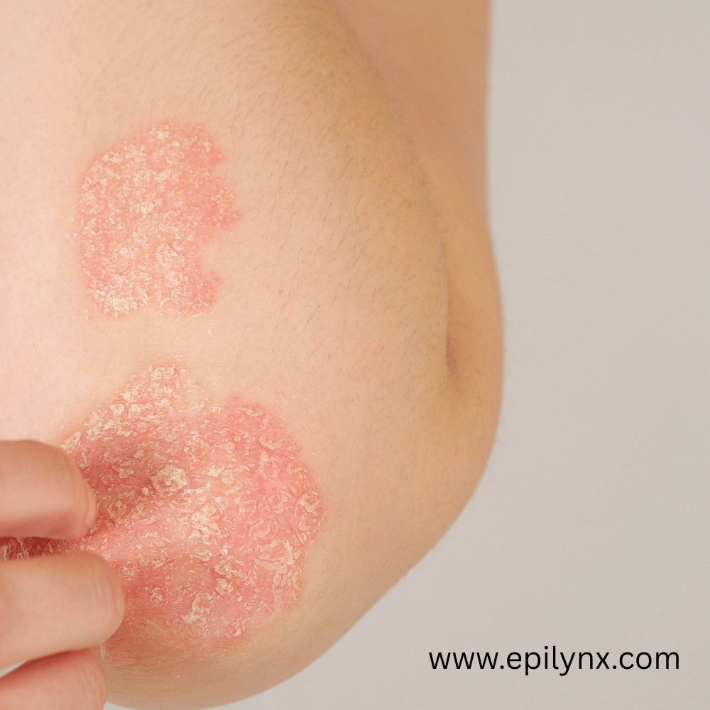 A gut-skin protocol for psoriasis and celiac disease