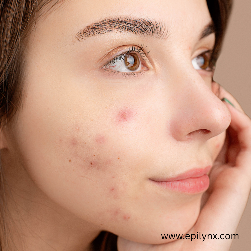 Teen Acne on Sensitive Skin: A Routine That Clears Without Wrecking the Barrier