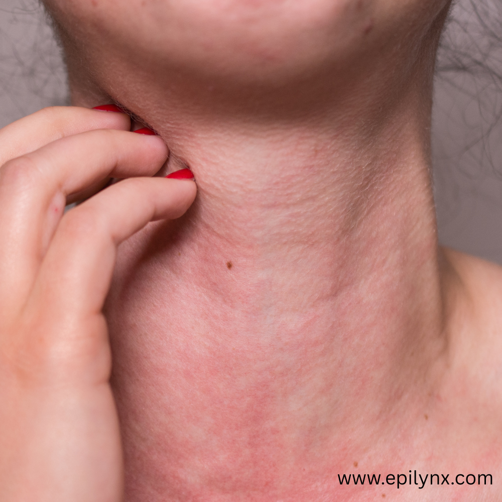 How skin can develop allergies before the digestive system does