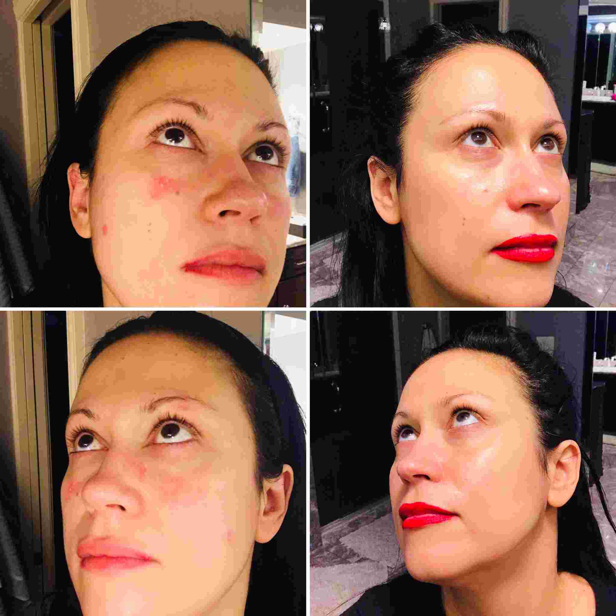 Before and After the use of EpiLynx