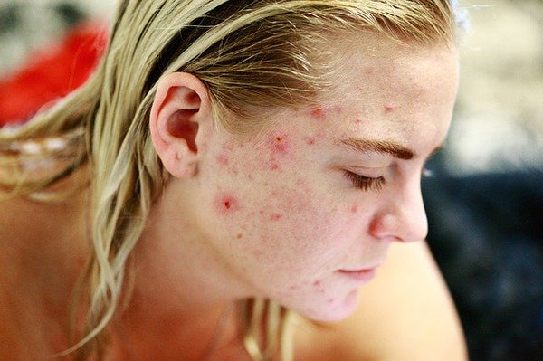 How Often You Should Wash Your Face If You Have Acne