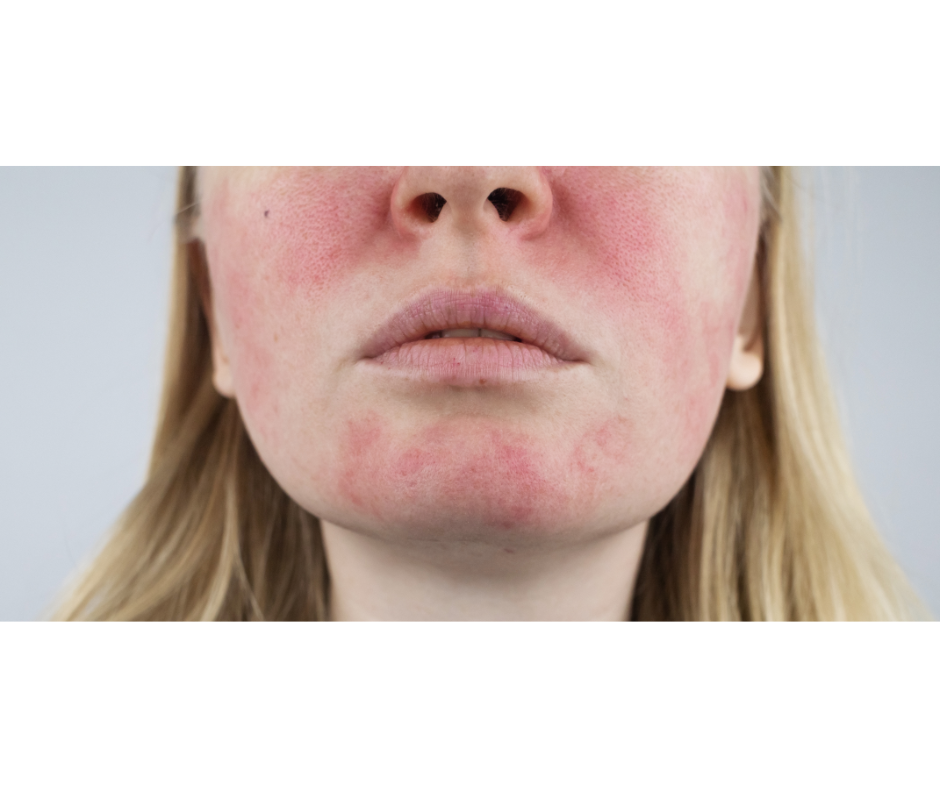 Rosacea Skin EpiLynx
