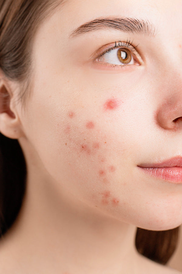 Epilynx blog skin acne