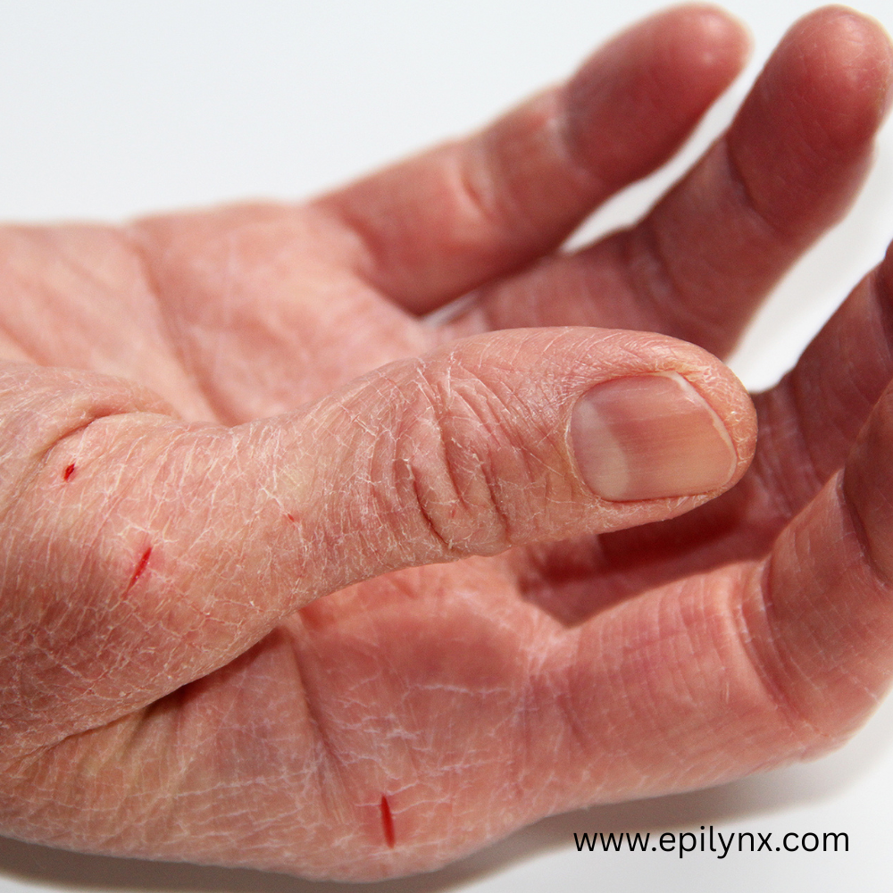 Hand Eczema and Cracked Hands: Why They Will Not Heal and What Finally Works