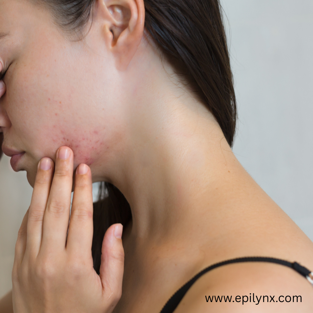 Rosacea: Calm, Protect, Glow